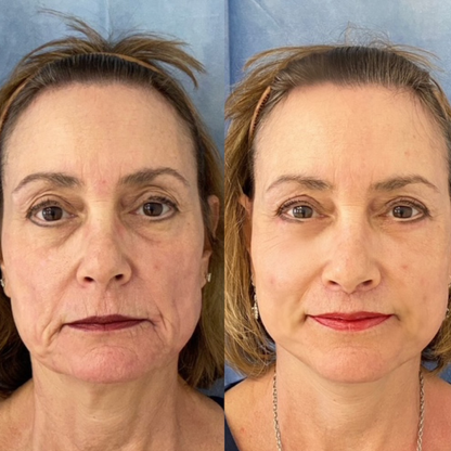 Needle-Free Growth Factor Serum | Early Access Black Friday Sale