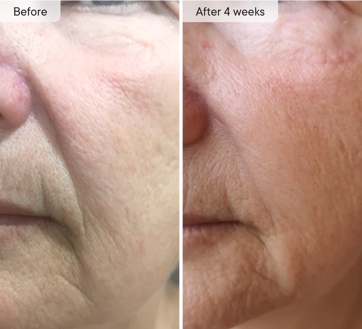 Micro-Infusion Targeted Patches | Early Access Black Friday Sale