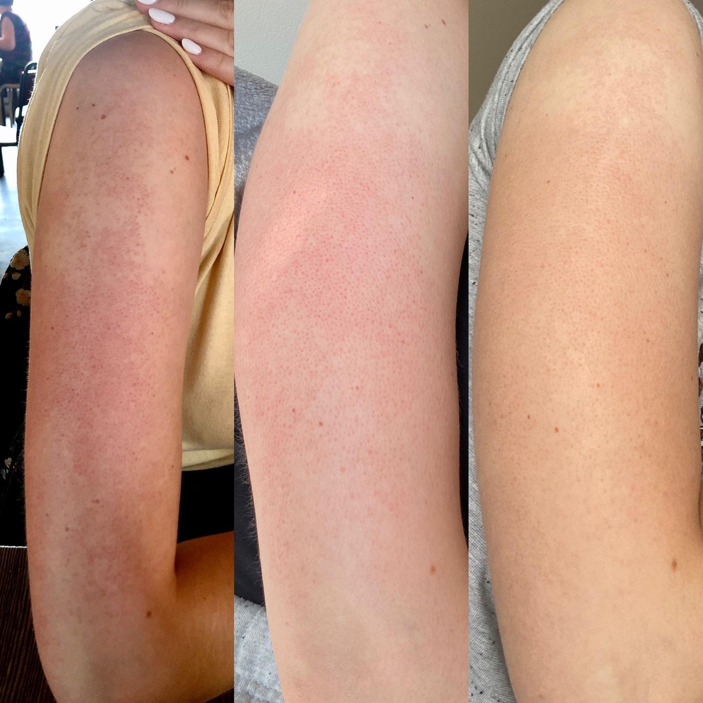 Hypochlorous Acid Peel Shot Duo For Face & Body | Early Access Black Friday Sale