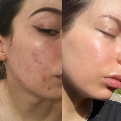 Hypochlorous Acid Peel Shot Duo For Face & Body | Early Access Black Friday Sale